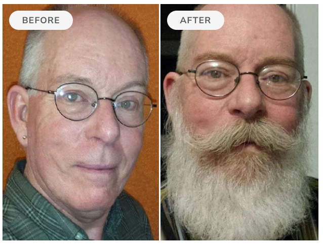 Before and after, 90 days of Beard Boost