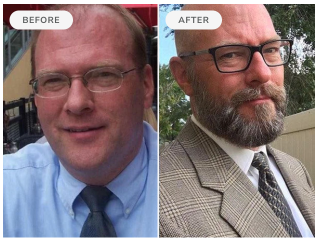 Before and after, 90 days of Beard Boost