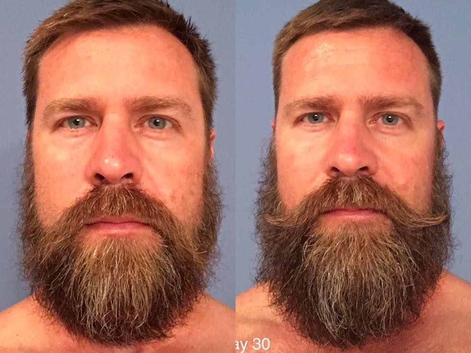 Before and after — 1 month on Beard Boost